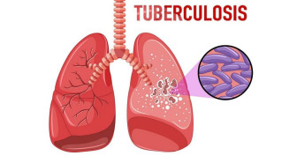 Что Вы должны знать о туберкулезе